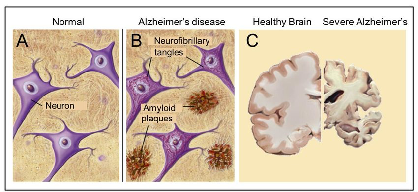 sự khác biệt giữa nào người bình thường và bệnh alzheimer